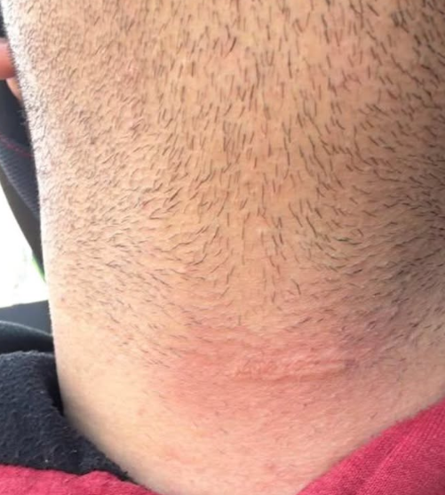 Motoboy fica ferido após ser atingido por fio de pipa