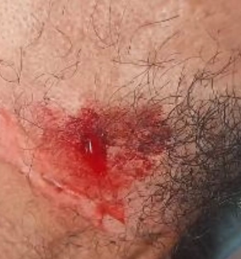 Homem ficou ferido após se enroscar em cabo solto no bairro Várzea do Padre.