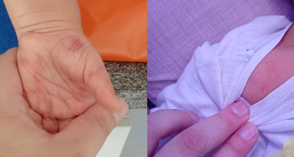 Menino de um ano e oito meses sofreu lesões na mão e no ombro.